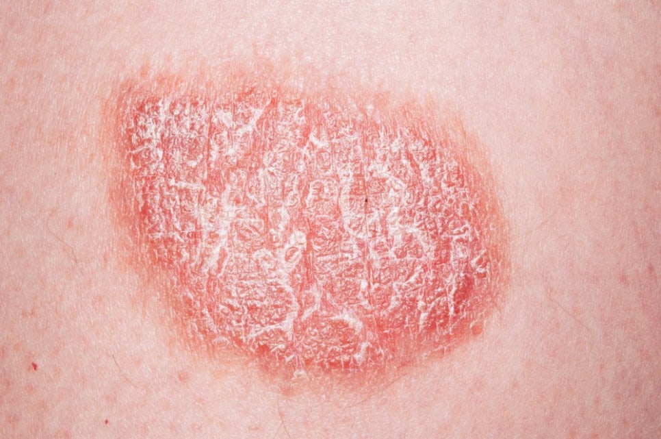 Sadang-dong Dermatology Clinic: Psoriasis Treatment—There Is a Reason Why Skin That Gets Worse the More You Scratch Keeps Recurring image 1