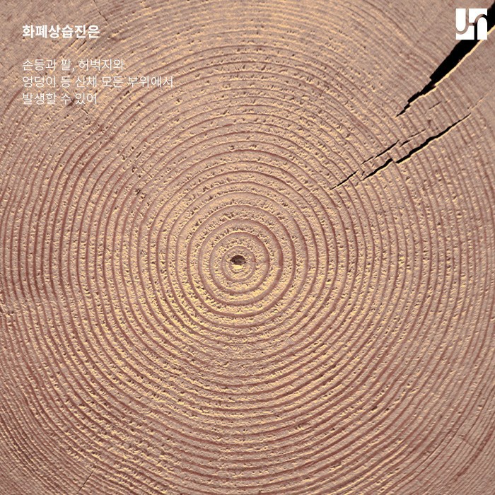 화폐상 습진 치료는 어떻게 해야 하나요? 관련 이미지 3