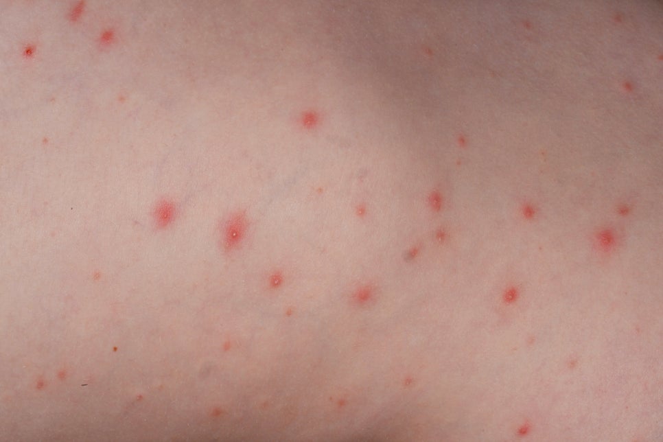 내방동 피부과 모낭염 원인과 증상 여드름과 헷갈리지 마세요 관련 이미지 1