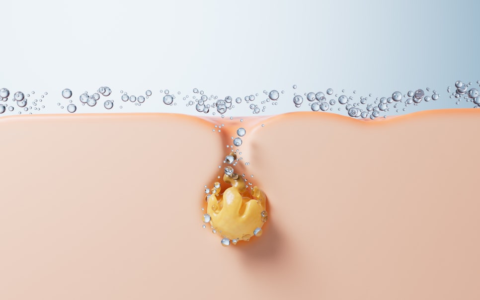 방배동 피부과 넓어진 모공을 축소하는 3단계 맞춤 치료법 관련 이미지 3