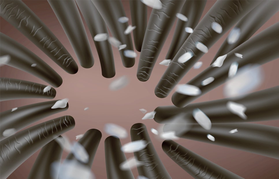 서초동 피부과 머리 비듬 생기는 원인, 지루성 두피염일까? 관련 이미지 3