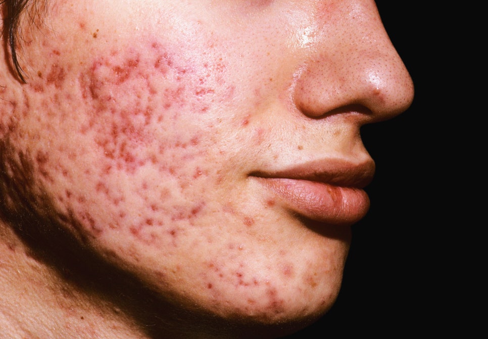 방배역 피부과 깊은 흉터부터 붉은 자국까지 여드름 흉터 치료 연고와 레이저 총정리 관련 이미지 1