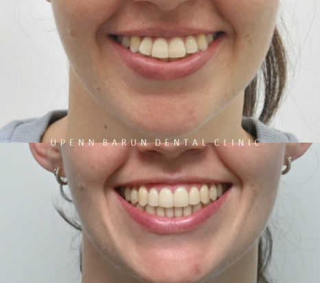 "치아가 앞으로 뻐드러졌어요!" 송파인비절라인다이아몬드등급치과에서!!(비발치인비절라인 뻐드렁니교정치과 돌출입교정치과) 관련 이미지 5