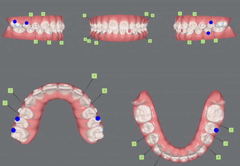송파인비절라인다이아몬드등급치과 에서 인비절라인으로 1차 2차 교정을 한번에! (송파인비절라인퍼스트 잠실어린이인비절라인 인비절라인소아교정 잠실소아교정 어린이반대교합) 관련 이미지 16