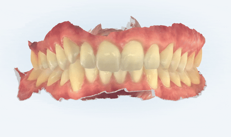 '옥니같이 보여요' 인비절라인급속교정 가능할까? with 캐리에모션장치 (잠실다이아몬드등급 인비절라인다이아몬드등급 서울다이아몬드등급치과 옥니인비절라인후기) 관련 이미지 4