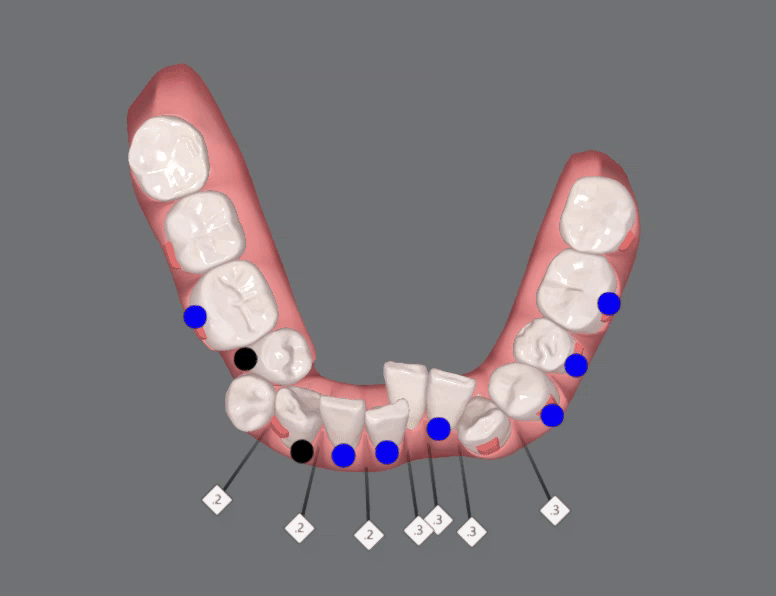 평생 삐뚤어진 치아가 고민이셨던 79세 고령환자분이 선택한 송파인비절라인다이아몬드등급 후기 (서울인비절라인전문치과 잠실인비절라인교정치과 노인교정 노인치아교정 노인교정치과) 관련 이미지 12