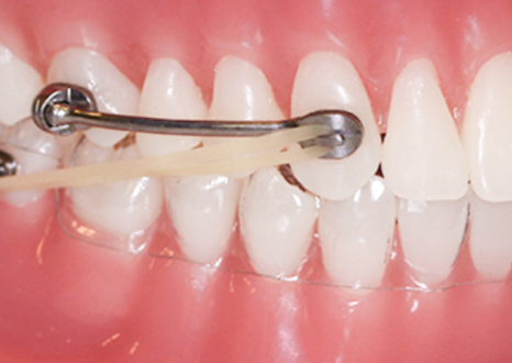 '옥니같이 보여요' 인비절라인급속교정 가능할까? with 캐리에모션장치 (잠실다이아몬드등급 인비절라인다이아몬드등급 서울다이아몬드등급치과 옥니인비절라인후기) 관련 이미지 7