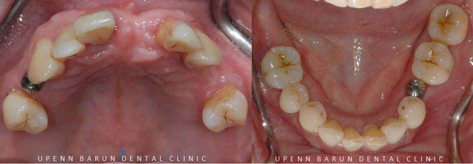 잠실새내역임플란트 잠실새내역치과 유펜바른치과에서 전체임플란트치료 ( 잠실임플란트후기 임플란트기간  전체임플란트) 관련 이미지 8