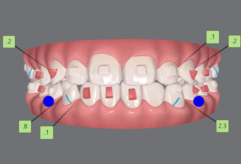 송파인비절라인다이아몬드등급치과 에서 인비절라인으로 1차 2차 교정을 한번에! (송파인비절라인퍼스트 잠실어린이인비절라인 인비절라인소아교정 잠실소아교정 어린이반대교합) 관련 이미지 13
