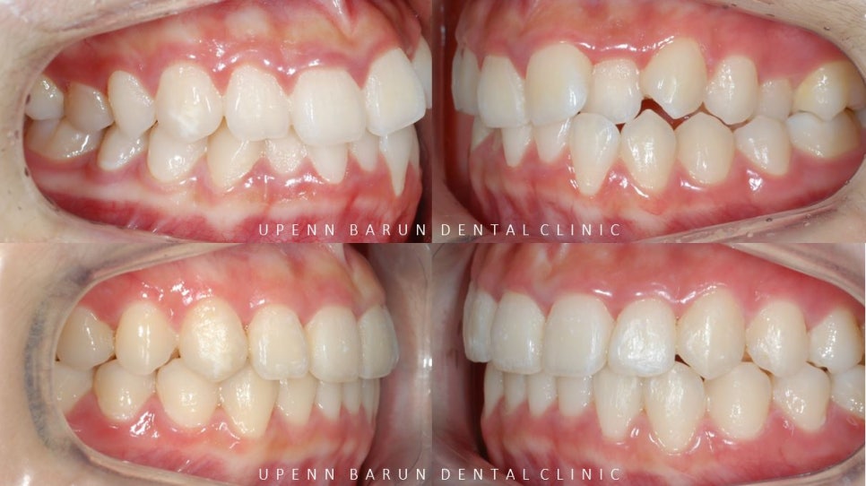 '웃을때 입을 자꾸 가려요'  활짝 웃은 중학생 비발치 인비절라인후기 (잠실새내인비절라인 청소년인비절라인 잠실교정치과) 관련 이미지 9