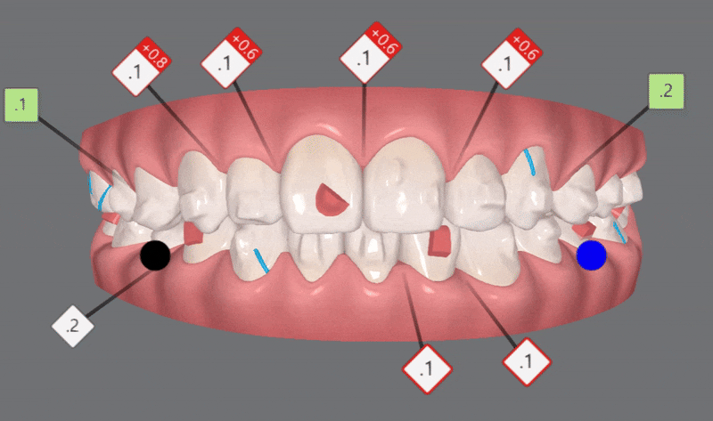2024년 송파구 단일 치과의원급 중 유일!!! 인비절라인다이아몬드등급 달성한 유펜바른치과의 청소년인비절라인 후기 (청소년반대교합 어린이반대교합 잠실인비절라인잘하는치과) 관련 이미지 15