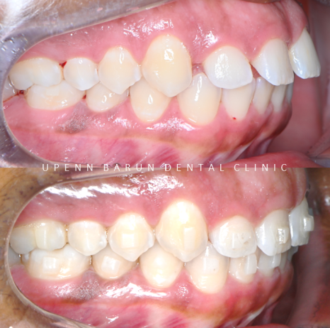 잠실인비절라인등급 잠실부분교정 앞니틈교정 인비절라인라이트 옵션으로 빠르게 해결한 후기 (삼성역부분교정 인비절라인앞니재교정 잠실역교정치과 삼전동인비절라인 삼전동교정치과) 관련 이미지 10
