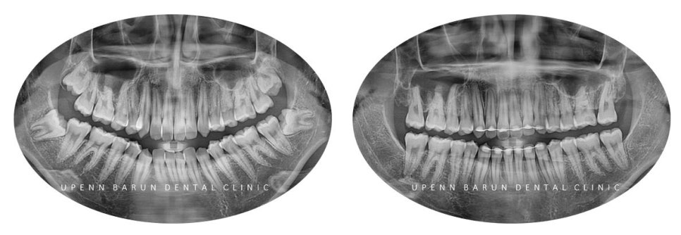 유학생치아교정 유학생교정치과 잠실교정치과 잠실데이몬교정 데이몬클리어교정 Wide Smile (송파교정치과 잠실새내교정치과 강동교정치과 헬리오시티교정치과 예쁜미소 Smile Arc) 관련 이미지 18