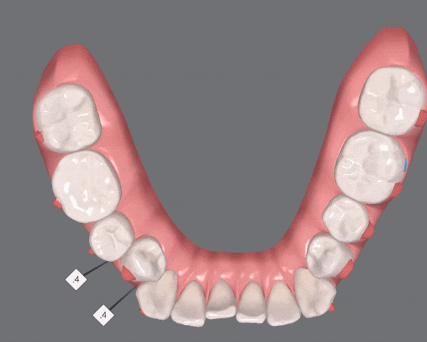 전세계 1400만명이 선택한 교정장치, 인비절라인 관련 이미지 5