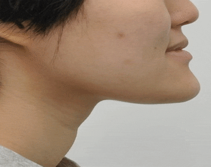 주걱턱교정, 수술교정, 양악수술도 잠실교정치과 유펜바른치과에서 관련 이미지 1