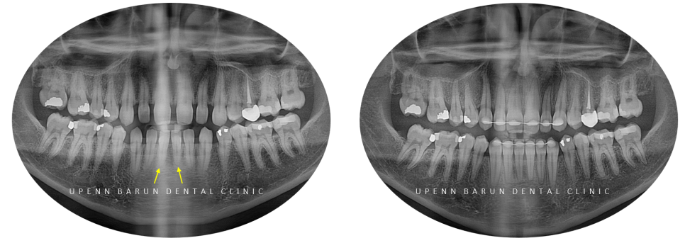 인비절라인높은등급 인비절라인플래티넘엘리트 잠실교정치과 잠실인비절라인 (잠실교정치과 송파인비절라인 인비절라인전후사진 인비절라인후기) 관련 이미지 5