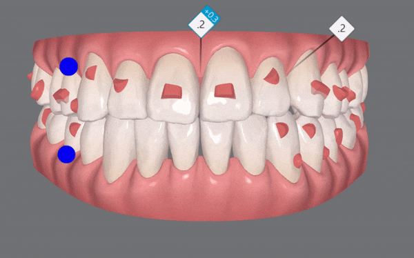 나스닥에 상장한 인비절라인, 잠실투명교정 잠실인비절라인 후기와 치아미백이 궁금하다면? 관련 이미지 9