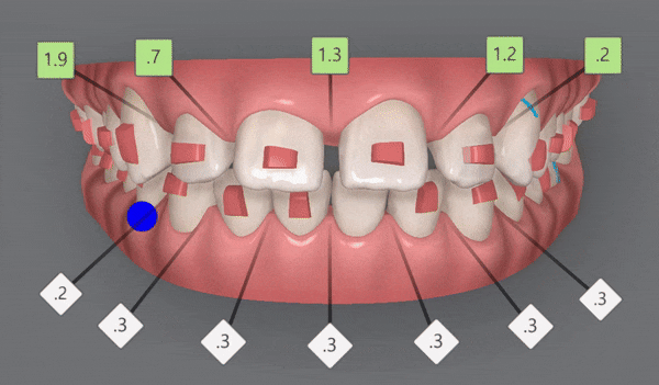 잠실인비절라인등급 잠실부분교정 앞니틈교정 인비절라인라이트 옵션으로 빠르게 해결한 후기 (삼성역부분교정 인비절라인앞니재교정 잠실역교정치과 삼전동인비절라인 삼전동교정치과) 관련 이미지 6