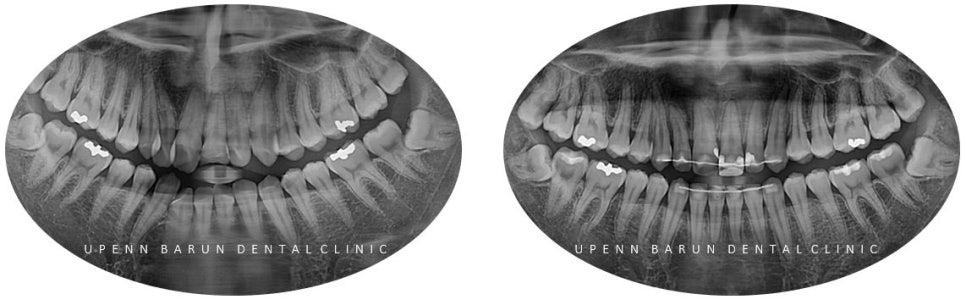잠실데이몬교정, 비발치교정, 잠실덧니교정 (AKA Damon Smile) 관련 이미지 12