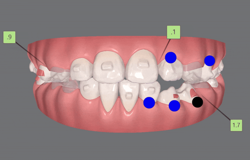 다이아몬드등급치과에서 인비절라인퍼스트로 반대교합 해결! 1차, 2차교정을 한번에!( 어린이반대교합 송파인비절라인퍼스트 잠실엘스상가교정치과 잠실인비절라인퍼스트 인비절라인스피커치과) 관련 이미지 12