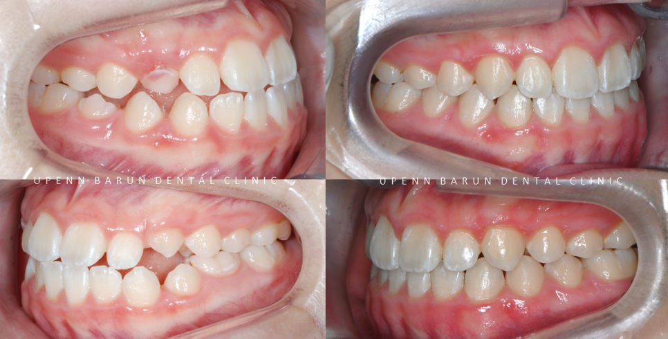 송파인비절라인다이아몬드등급치과 에서 인비절라인으로 1차 2차 교정을 한번에! (송파인비절라인퍼스트 잠실어린이인비절라인 인비절라인소아교정 잠실소아교정 어린이반대교합) 관련 이미지 8