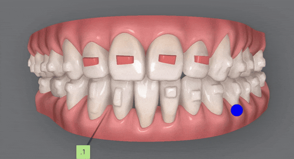 인비절라인 공식 스피커가 상주하고 치료하는 송파교정잘하는치과 유펜바른치과 (잠실성인교정 잠실재교정 잠실인비절라인 성인인비절라인교정 잠실나루역교정치과 문정동교정치과 삼전역교정치과) 관련 이미지 14