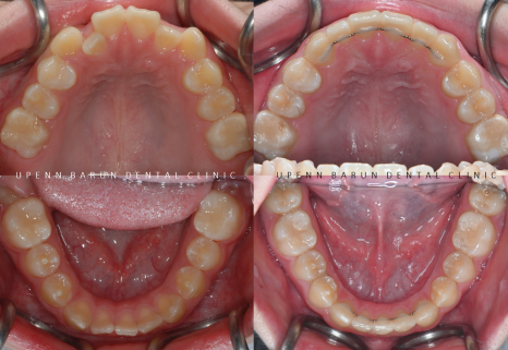 2024년 송파구 단일 치과의원급 중 유일!!! 인비절라인다이아몬드등급 달성한 유펜바른치과의 청소년인비절라인 후기 (청소년반대교합 어린이반대교합 잠실인비절라인잘하는치과) 관련 이미지 19