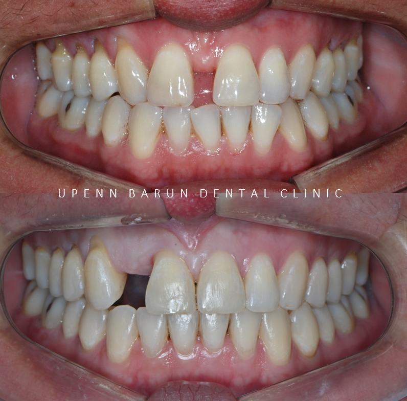 같은원장님께 보철치료와 교정치료를 동시에! 앞니사이 틈 해결한 후기 ( 송파교정치과 잠실교정잘하는치과 송파교정잘하는치과 올림픽파크포레온교정치과 올림픽파크포레온인비절라인치과) 관련 이미지 10