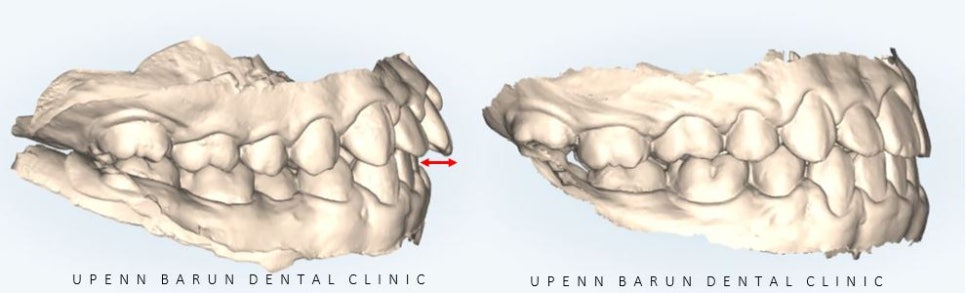 잠실청소년교정 청소년소년돌출입교정 잠실발치교정은 유펜바른치과에서! (잠실나루역교정치과 삼전역교정치과 잠실새내교정치과 돌출입전후 발치교정전후사진) 관련 이미지 13