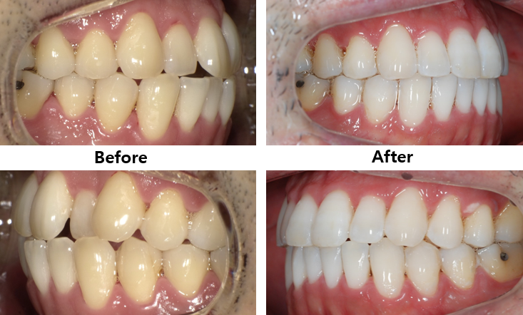 나스닥에 상장한 인비절라인, 잠실투명교정 잠실인비절라인 후기와 치아미백이 궁금하다면? 관련 이미지 17