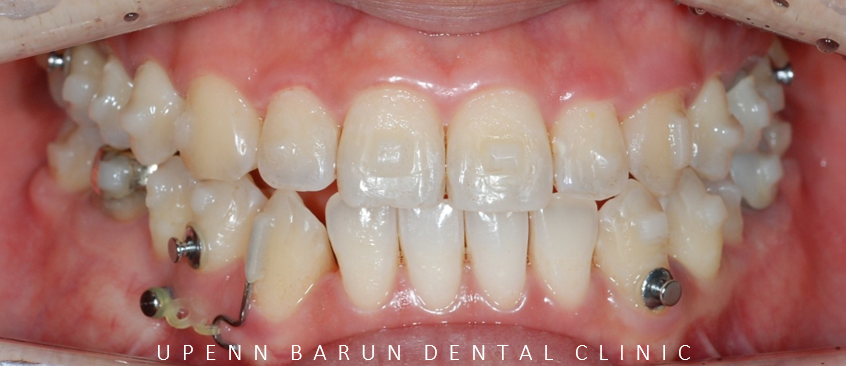 주걱턱 반대교합도 잠실인비절라인 잠실교정치과 유펜바른치과에서!(비발치주걱턱교정 잠실성인교정 반대교합인비절라인 잠실교정치과 주걱턱교정후기) 관련 이미지 14