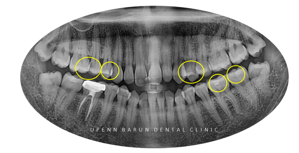 잇몸웃음 거미스마일(gummy smile) 교정후 입동굴 예쁜미소로!(잠실교정치과 거미스마일교정후기 거미스마일교정전후 클라리티세라믹교정 미니스크류교정 미국치과교정과전문의) 관련 이미지 8
