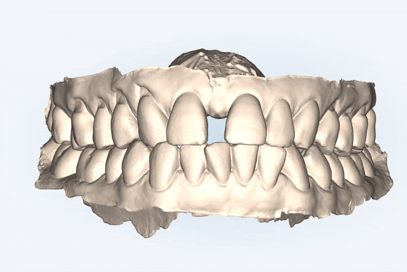 같은원장님께 보철치료와 교정치료를 동시에! 앞니사이 틈 해결한 후기 ( 송파교정치과 잠실교정잘하는치과 송파교정잘하는치과 올림픽파크포레온교정치과 올림픽파크포레온인비절라인치과) 관련 이미지 3