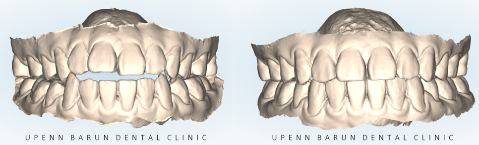반대교합+개방교합 비수술교정 유펜바른치과에서 재교정한 후기! ( 비발치개방교합 비발치반대교합 재교정후기 잠실교정치과 미니스크류비수술교정 악궁확장장치 MARPE) 관련 이미지 7