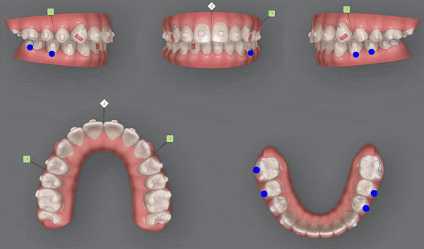 잠실소아인비절라인 잠실어린이인비절라인 송파인비절라인 잠실인비절라인후기 (잠실새내교정치과 엘스상가교정치과 파인애플상가교정치과 잠실새내역인비절라인 청소년교정후기 잠실인비절라인퍼스트) 관련 이미지 14