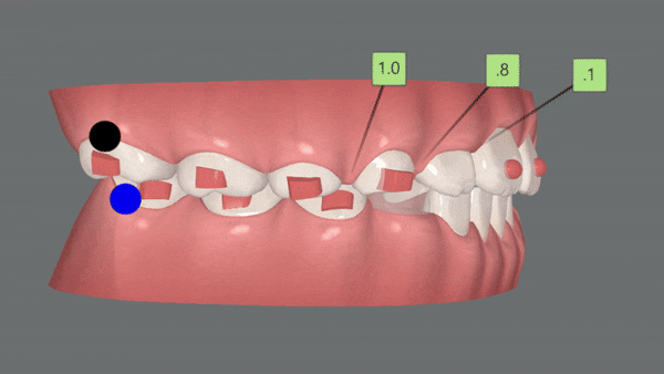 유독 튀어나와 다치기 쉬운 앞니! INVISALIGN FIRST로 8개월만에 끝낸 후기 (송파인비절라인소아교정 인비절라인1차교정 송파인비절라인퍼스트  송파인비절라인어린이교정) 관련 이미지 13