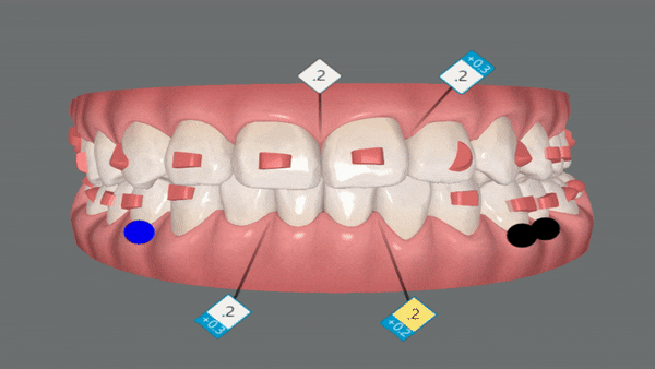 '웃을때 입을 자꾸 가려요'  활짝 웃은 중학생 비발치 인비절라인후기 (잠실새내인비절라인 청소년인비절라인 잠실교정치과) 관련 이미지 10
