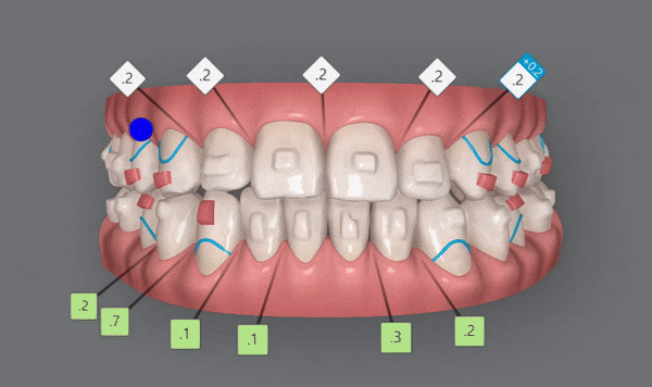 주걱턱 반대교합도 잠실인비절라인 잠실교정치과 유펜바른치과에서!(비발치주걱턱교정 잠실성인교정 반대교합인비절라인 잠실교정치과 주걱턱교정후기) 관련 이미지 19