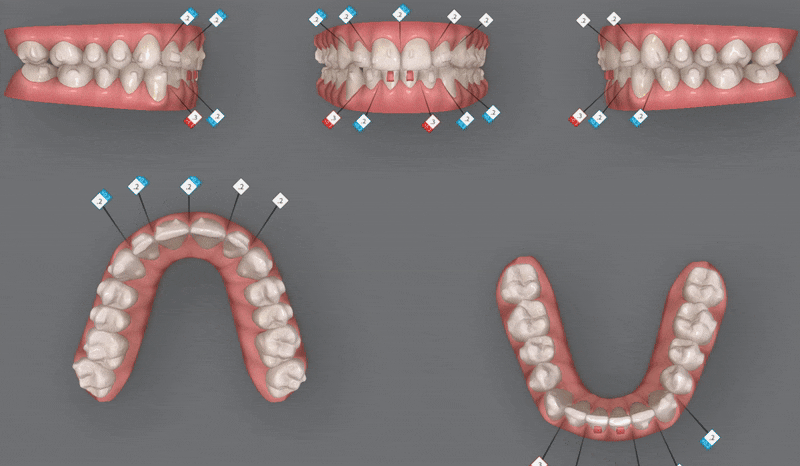 인비절라인다이아몬드등급치과에서 28개의 교정장치로 고민 해결한 후기가 궁금하다면? (잠실송곳니덧니교정 잠실인비절라인 인비절라인교정기간 투명교정장치후기 잠실인비절라인후기) 관련 이미지 9