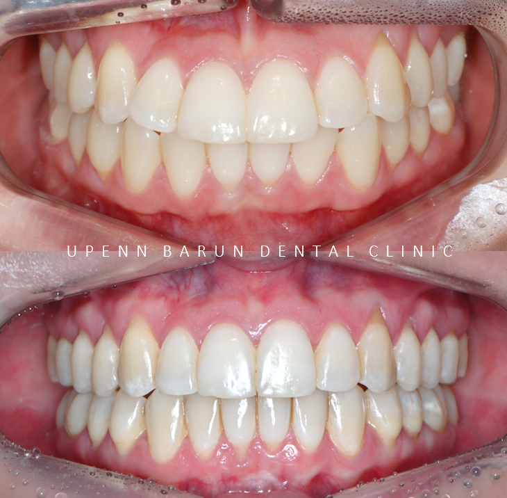 "치아가 앞으로 뻐드러졌어요!" 송파인비절라인다이아몬드등급치과에서!!(비발치인비절라인 뻐드렁니교정치과 돌출입교정치과) 관련 이미지 7