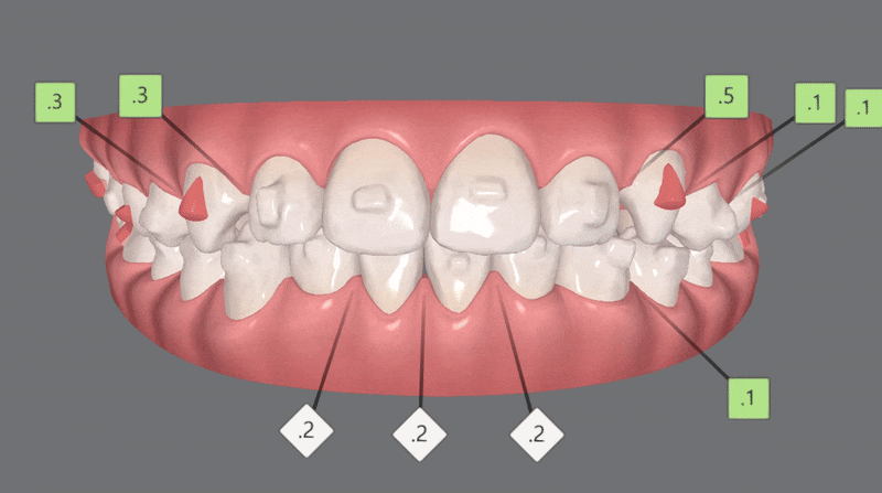 다이아몬드등급치과에서 인비절라인퍼스트로 반대교합 해결! 1차, 2차교정을 한번에!( 어린이반대교합 송파인비절라인퍼스트 잠실엘스상가교정치과 잠실인비절라인퍼스트 인비절라인스피커치과) 관련 이미지 16