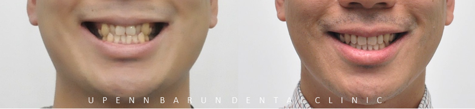 잠실덧니교정 인비절라인으로 컴플렉스 해결! (비발치교정 인비절라인등급 인비절라인후기 ) 관련 이미지 4