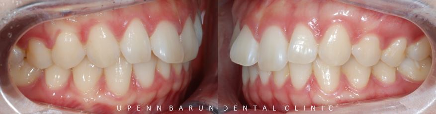 앞니부분교정 인비절라인라이트로 해결하기 (잠실인비절라인치과 송파인비절라인치과 잠실새내인비절라인치과 강동인비절라인치과 헬리오시티인비절라인 송파역인비절라인 석촌역인비절라인) 관련 이미지 6