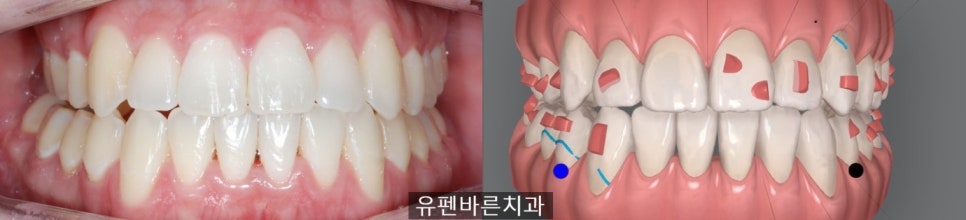 앞니끼리 맞물리지 않는데 인비절라인으로 교정 가능한가요? 관련 이미지 7