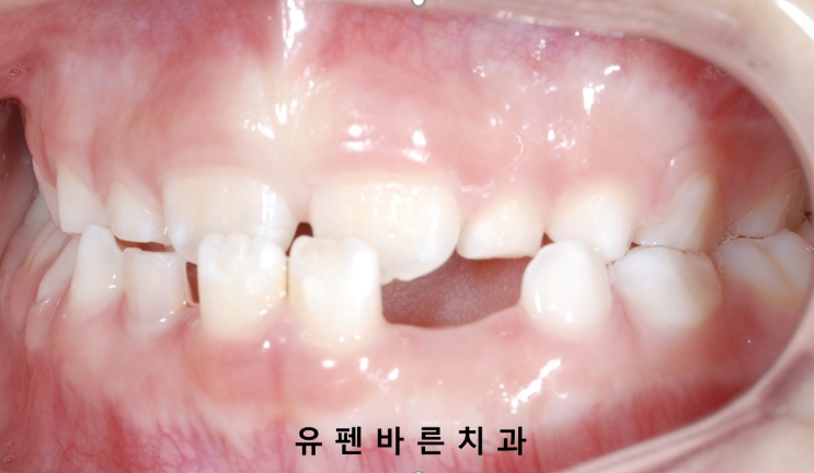 아이가 반대교합(주걱턱)인데 1차교정을 꼭해야 하나요? 관련 이미지 5