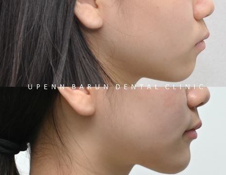 잠실새내역청소년교정 잠실돌출입발치교정은 유펜바른치과!(잠실중학생발치교정 잠실무턱교정 잠실새내소아교정치과 잠실새내교정잘하는치과 발치교정외모변화) 관련 이미지 12