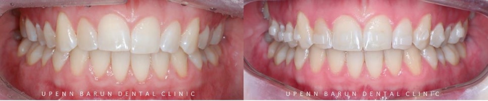 잠실교정치과 유펜바른치과의 인비절라인익스프레스가 특별한 이유 (5개월 인비절라인급속교정 잠실인비절라인 송파인비절라인 인비절라앞니부분교정) 관련 이미지 10