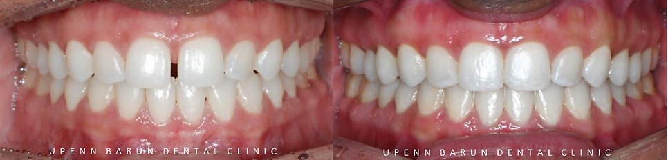 앞니벌어짐 인비절라인익스프레스로 해결하기 (인비절라인앞니부분교정 인비절라인재교정 송파인비절라인 잠실인비절라인 잠실교정치과 인비절라인익스프레스비용) 관련 이미지 16