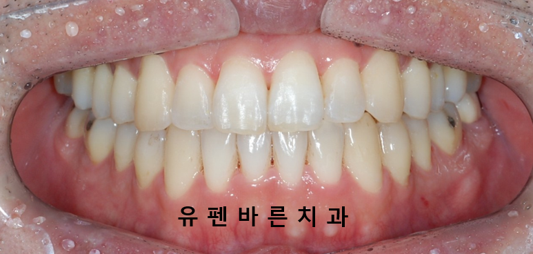 나스닥에 상장한 인비절라인, 잠실투명교정 잠실인비절라인 후기와 치아미백이 궁금하다면? 관련 이미지 8