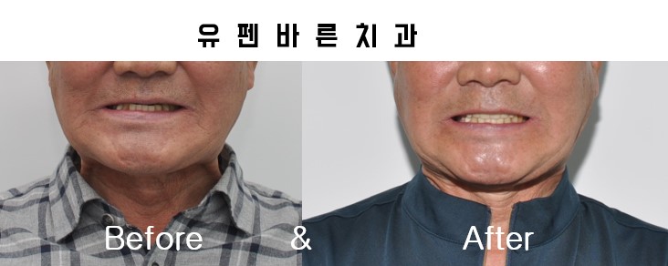 해보니까 임플란트가 편해요!!! 관련 이미지 8